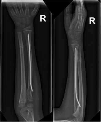 Case Report: The unique case of flexible intramedullary nailing of pediatric radius complicated with temporary radial nerve’s motor branch damage